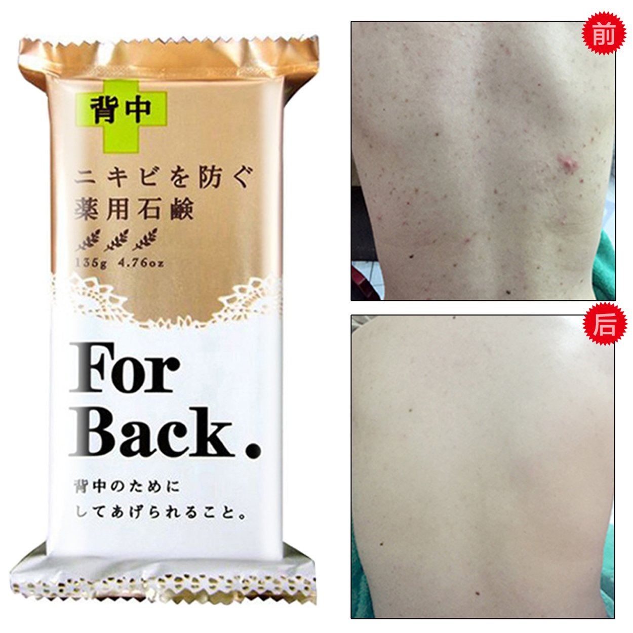 Pelican For Back Medicated Acne Soap 135 g.