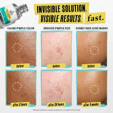 Kiehl's Blemish-Clearing Solution 15 ml.